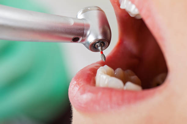 Best Emergency Wisdom Teeth Removal in Mantua, UT